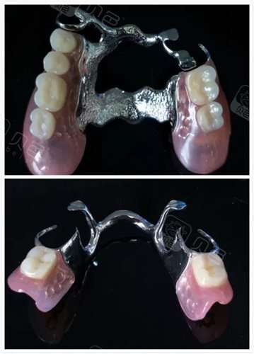 假牙支架多少钱一个详解一般活动假牙的支架一副价格费用