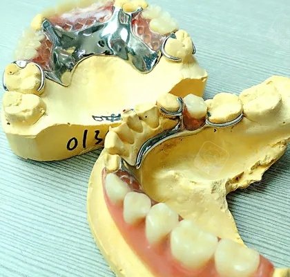 详解一般活动假牙的支架一副价格费用! - 贝色口腔