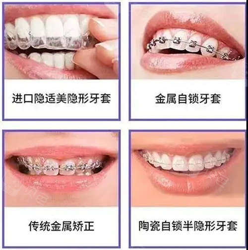 聊城牙齿矫正医院价格表分享整牙大概多少钱