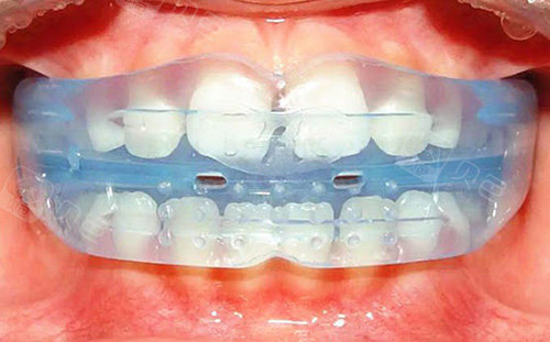 牙齿矫正eta和mrc有什么不同?从eta和mrc矫正区别来分析哪个好!