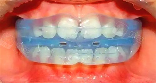 国外禁用儿童mrc矫正器是真的吗了解mrc的利弊就明白了