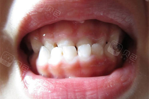 尤其是还在发育期的宝宝,发现孩子牙齿有排列不齐或稀疏,错位等问题