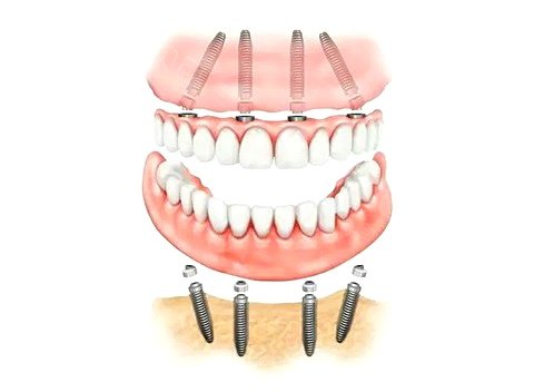 先说说活动假牙,活动假牙比较常见,价格相对比较实惠,制作也比较简单.