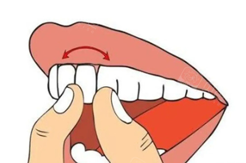 固定松动牙大概要多少钱得看你牙齿松动原因和松动程度