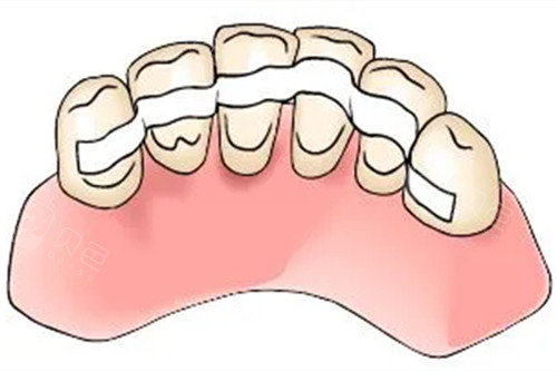 固定松动牙大概要多少钱 得看你牙齿松动原因和松动程度!