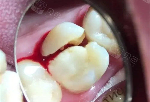 就觉得不对劲,赶紧让老公看了一下,老公看完之后说我牙齿裂开了,然后