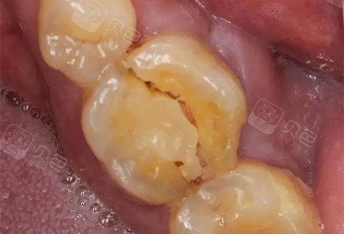 根管治疗后牙齿劈裂了而且牙齿劈裂了一半很松动该怎么