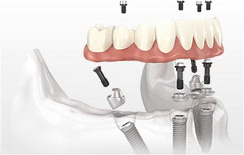 其中all-on-4种植技术针对全口或半口牙颌种植进行诊疗种植,利用4颗