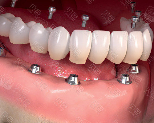 种植牙演示图