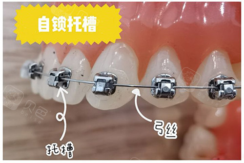 详述金属自锁托槽进口与国产的区别优点和缺点对比哪个好
