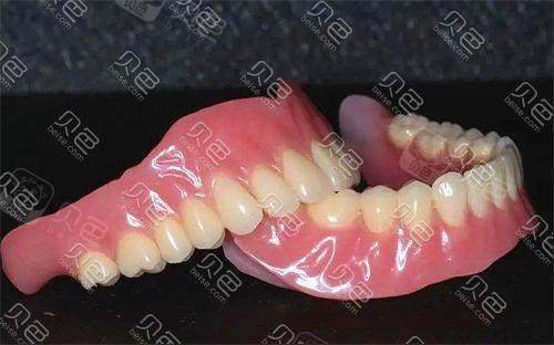 半口义齿示意图
