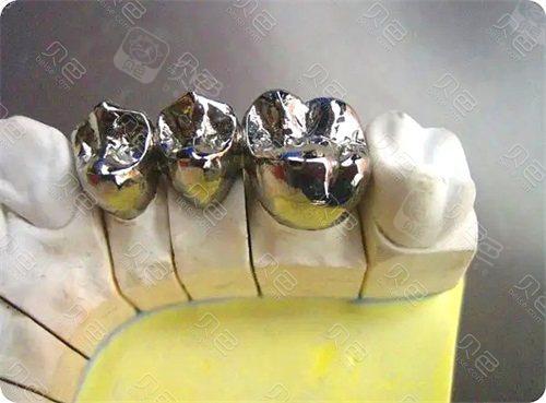 纯钛多颗假牙示意图