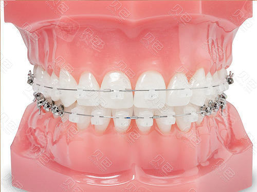 美国奥美科 damon clear自锁矫正器