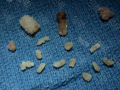 拔出的牙齿残留部位