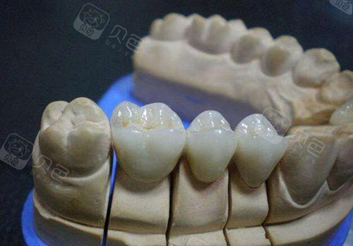 2022年烤瓷牙全瓷牙冠价格一览表公开一千八一颗不算贵