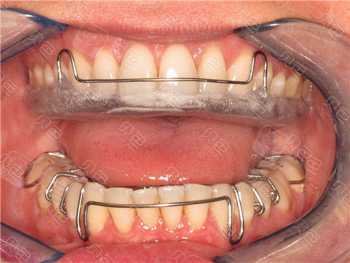 为什么钢丝保持器比透明保持器贵?这里面差别大着呢!