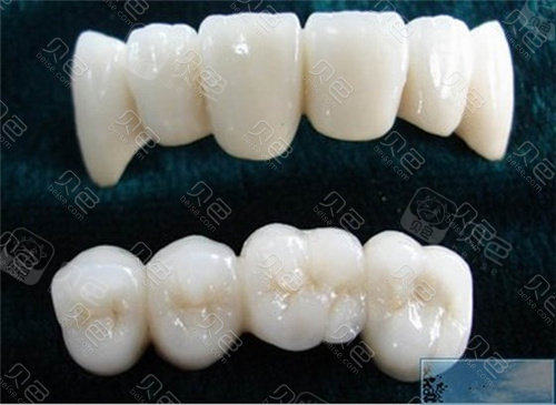全瓷牙桥冠成品