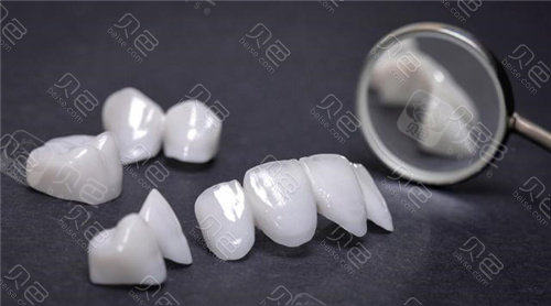 前牙美学玻璃陶瓷牙冠