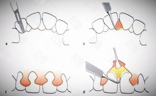 牙龈翻瓣手术示意图
