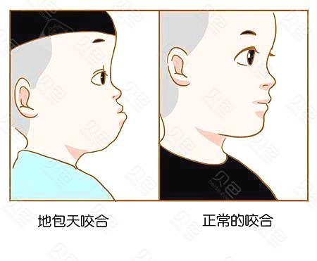 儿童牙齿矫正示意图
