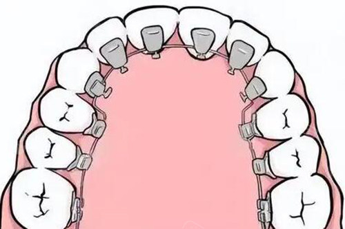 舌侧正畸卡通图照片