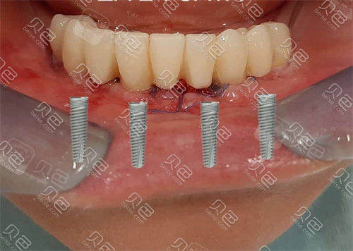 悦康口腔医院好不好本文测评悦康口腔种植牙技术附地址
