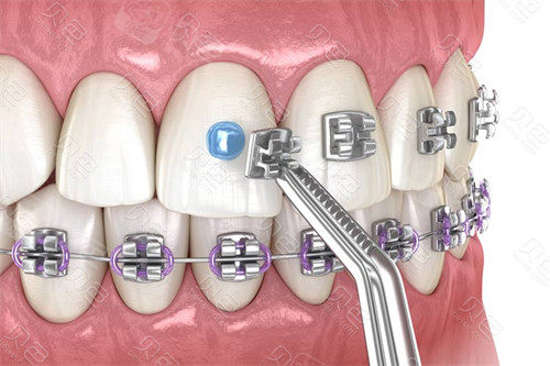 金属托槽矫正展示图