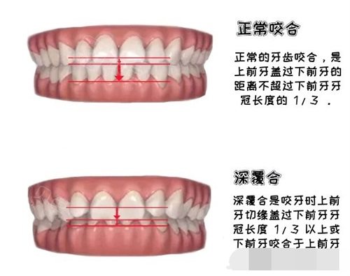 公布长沙深覆合深覆盖正畸价格深覆合深覆盖牙齿矫正费用