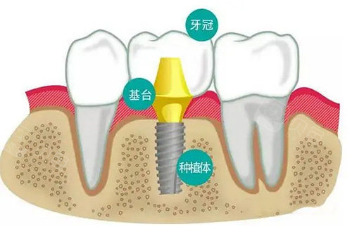 分段种植牙结构分析图