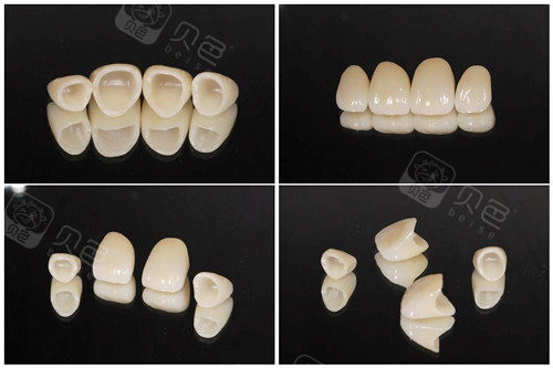 可是铸瓷牙不太适合做连冠的修复,用于单颗牙冠修复非常好,因为透光性