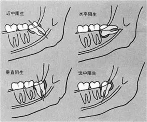 舌向阻生智齿