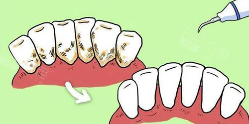 牙周洁牙改善展示图照片