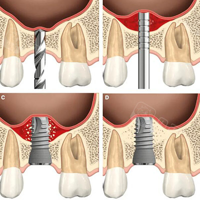 之所以要做上颌窦提升改善,主要是因为牙齿缺牙时间相对长,牙槽骨会