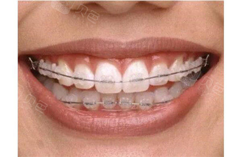 陶瓷自锁矫正图