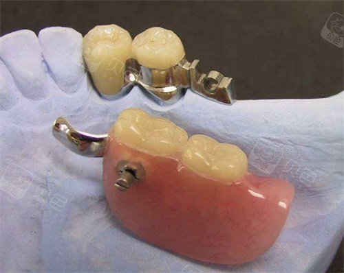 精密附着体活动义齿示意图