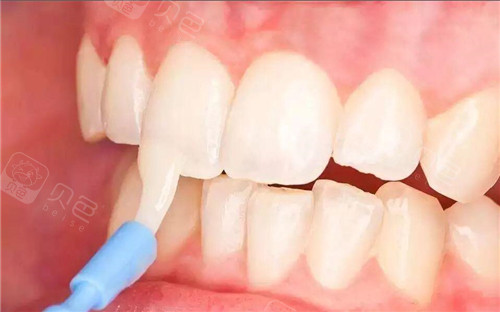 牙齿涂氟示意图