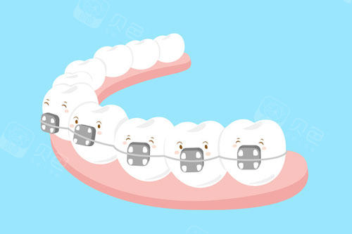 金属矫正牙套卡通图