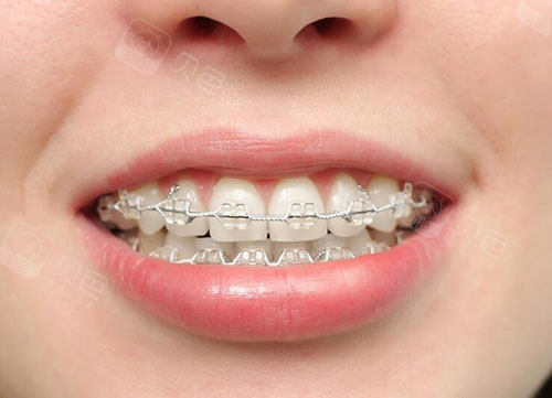 半透明陶瓷牙齿矫正牙套