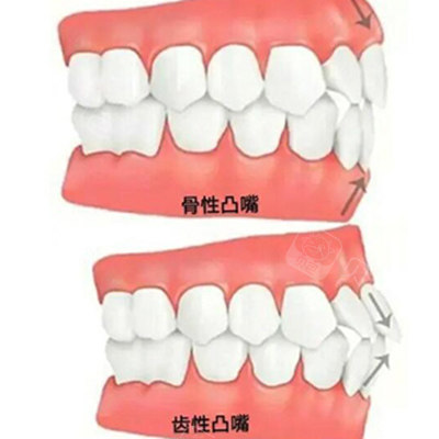 骨性凸嘴和牙性凸嘴
