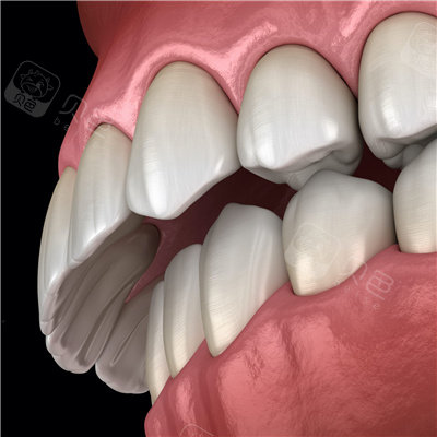 只需要进行正常的牙齿矫正就可以了;对于轻度的骨性龅牙,也可以采用