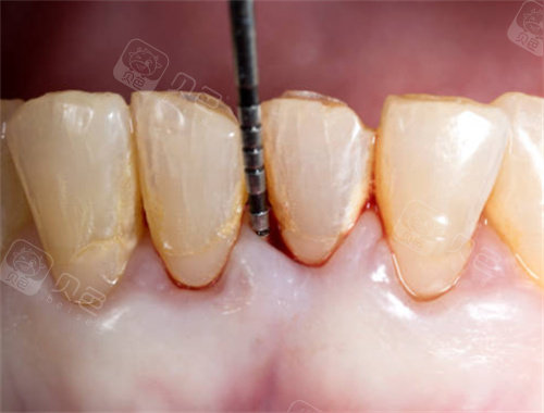 龈下刮治示意图