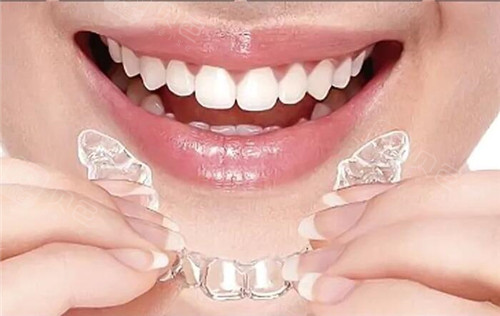 牙齿隐形矫治器图