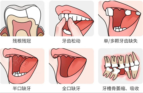 种植牙适应症图片