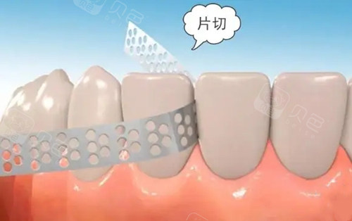片切是牙齿矫正中的概念,大名叫"领面去釉",非常好理解,就是把两颗