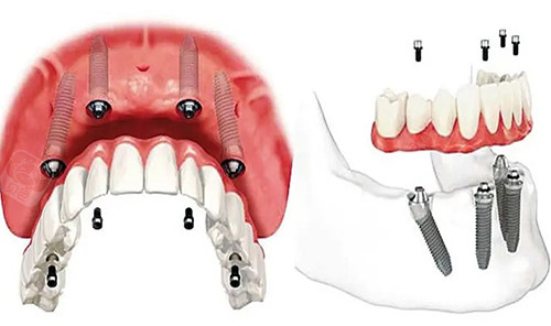 半口种植牙示意图