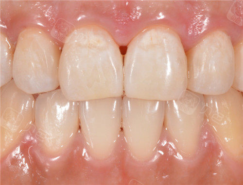 牙齿龋坏龋洞照片