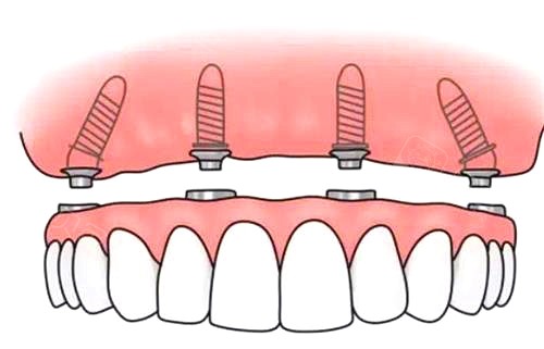 半口种植牙示意图