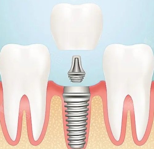 种植牙示意图