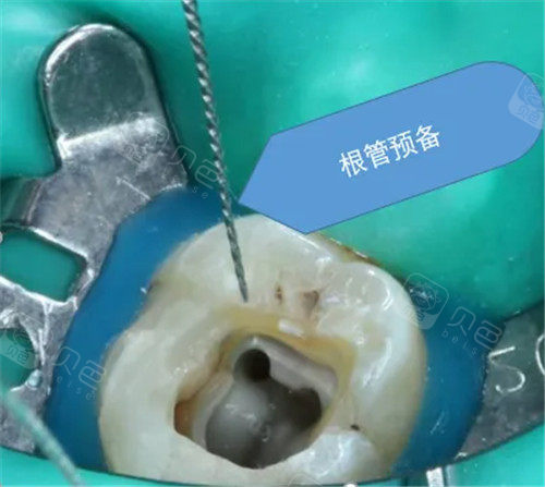 根管预备照片