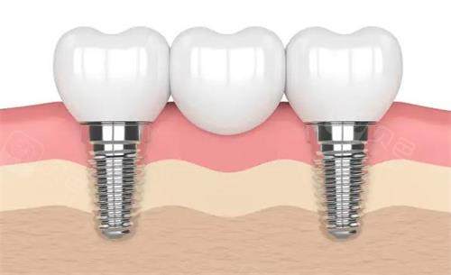 银川艾齿口腔医院种植牙图